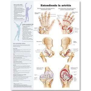 Understanding Arthritis in Spanish Chart/Poster  